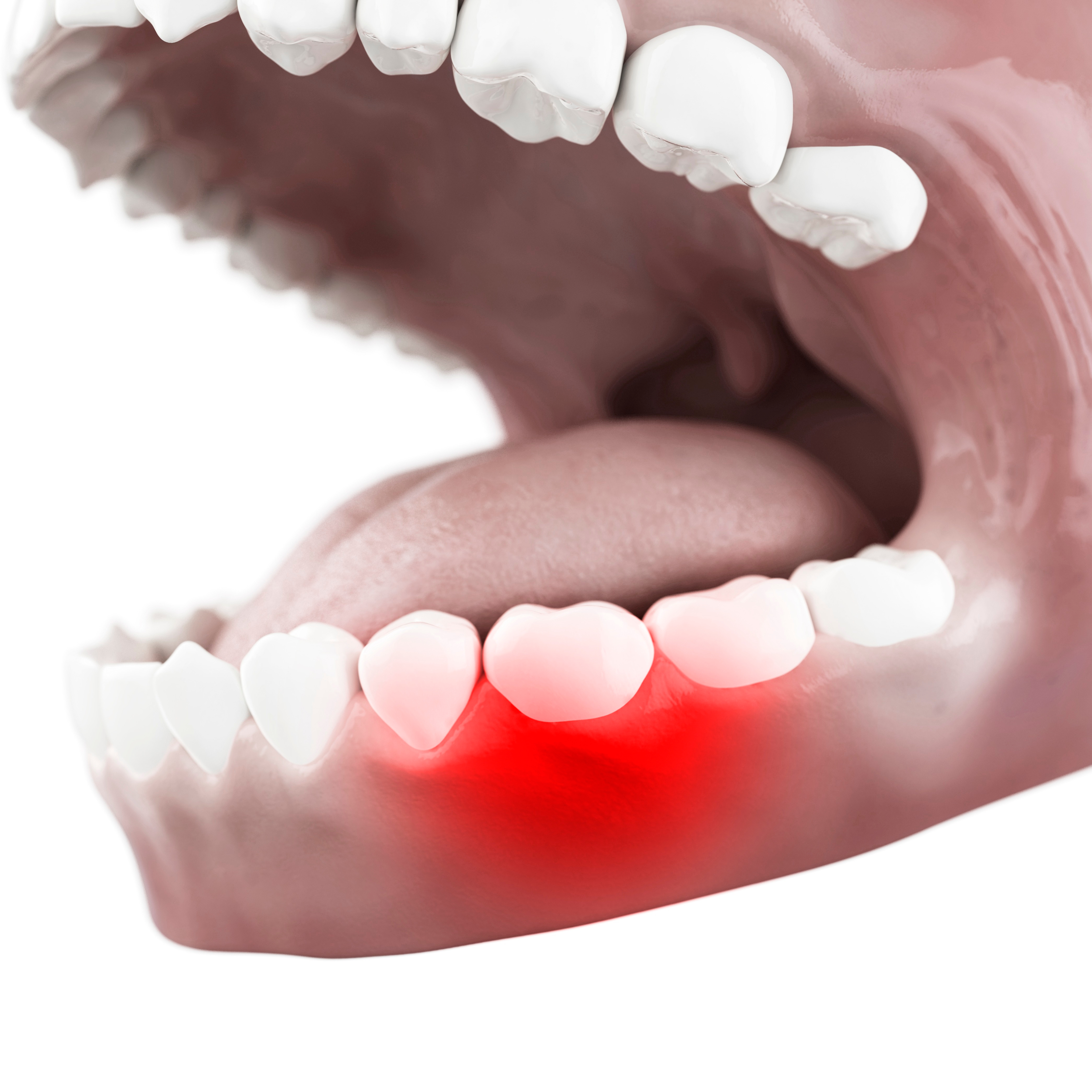 잇몸치료 / 잇몸재건 이미지